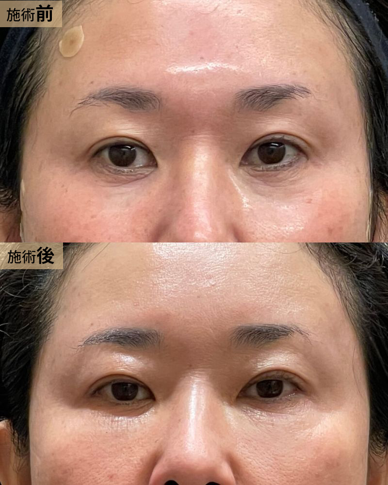 お顔の脂肪吸引3部位（おでこ・こめかみ・目の下）