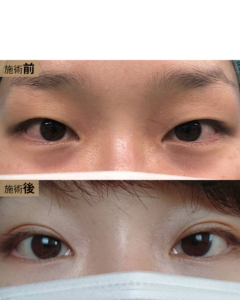 二重術（２点表留め）