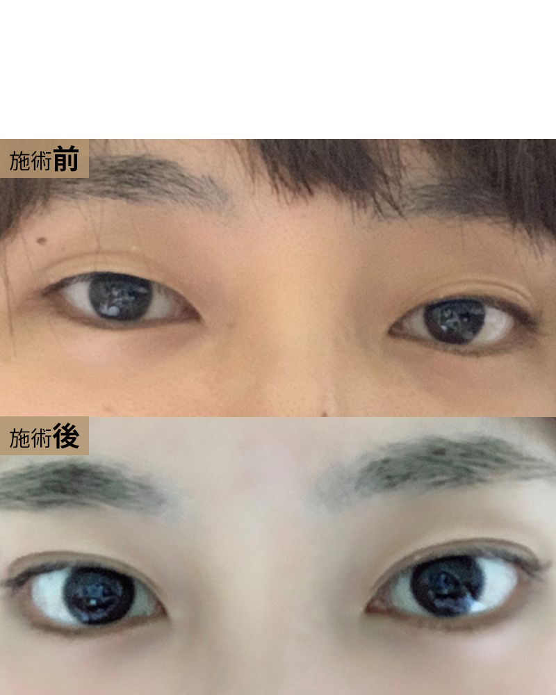 二重術（２点表留め）