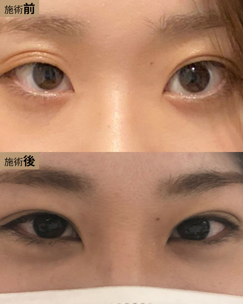 二重術（２点表留め）