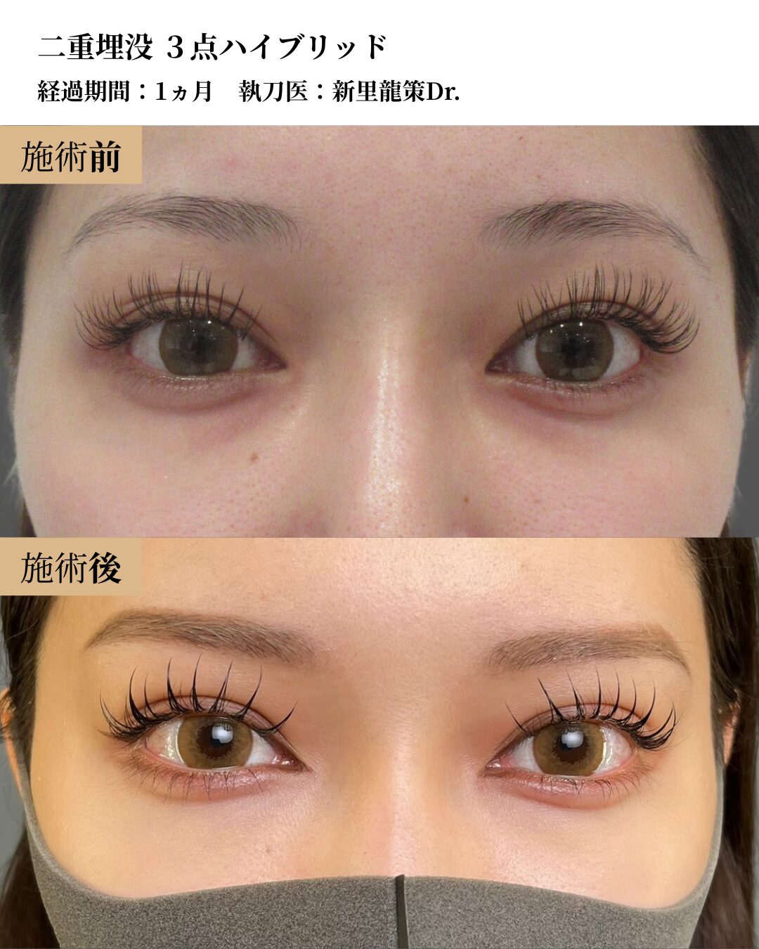 二重術（二重埋没３点ハイブリッド）