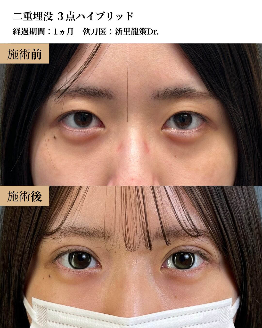 二重術（二重埋没３点ハイブリッド）