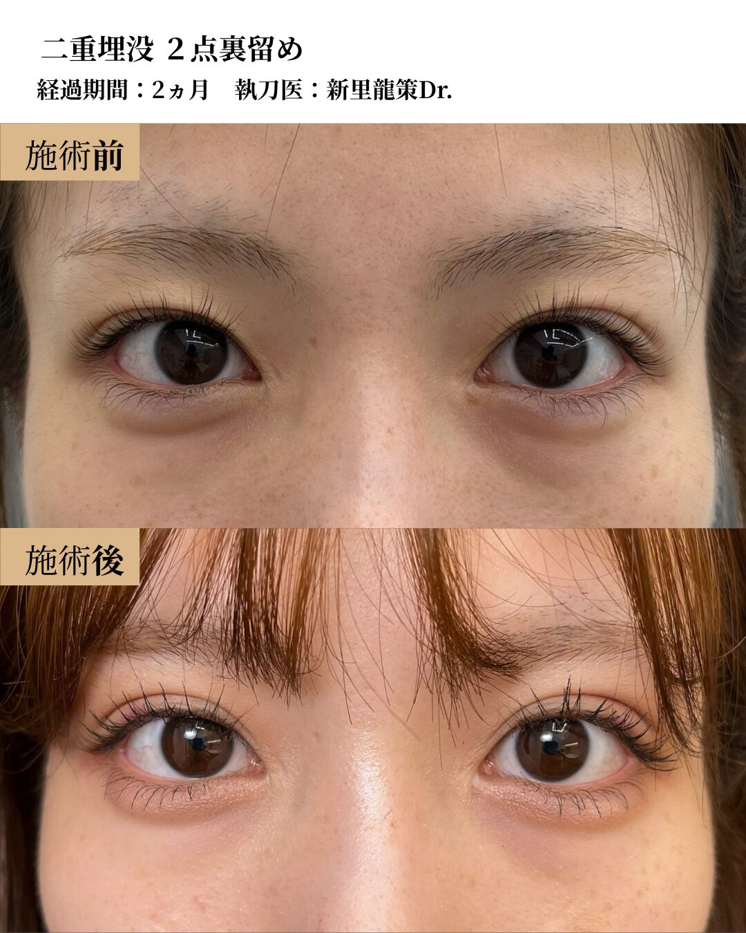 二重術（二重埋没２点裏留め）