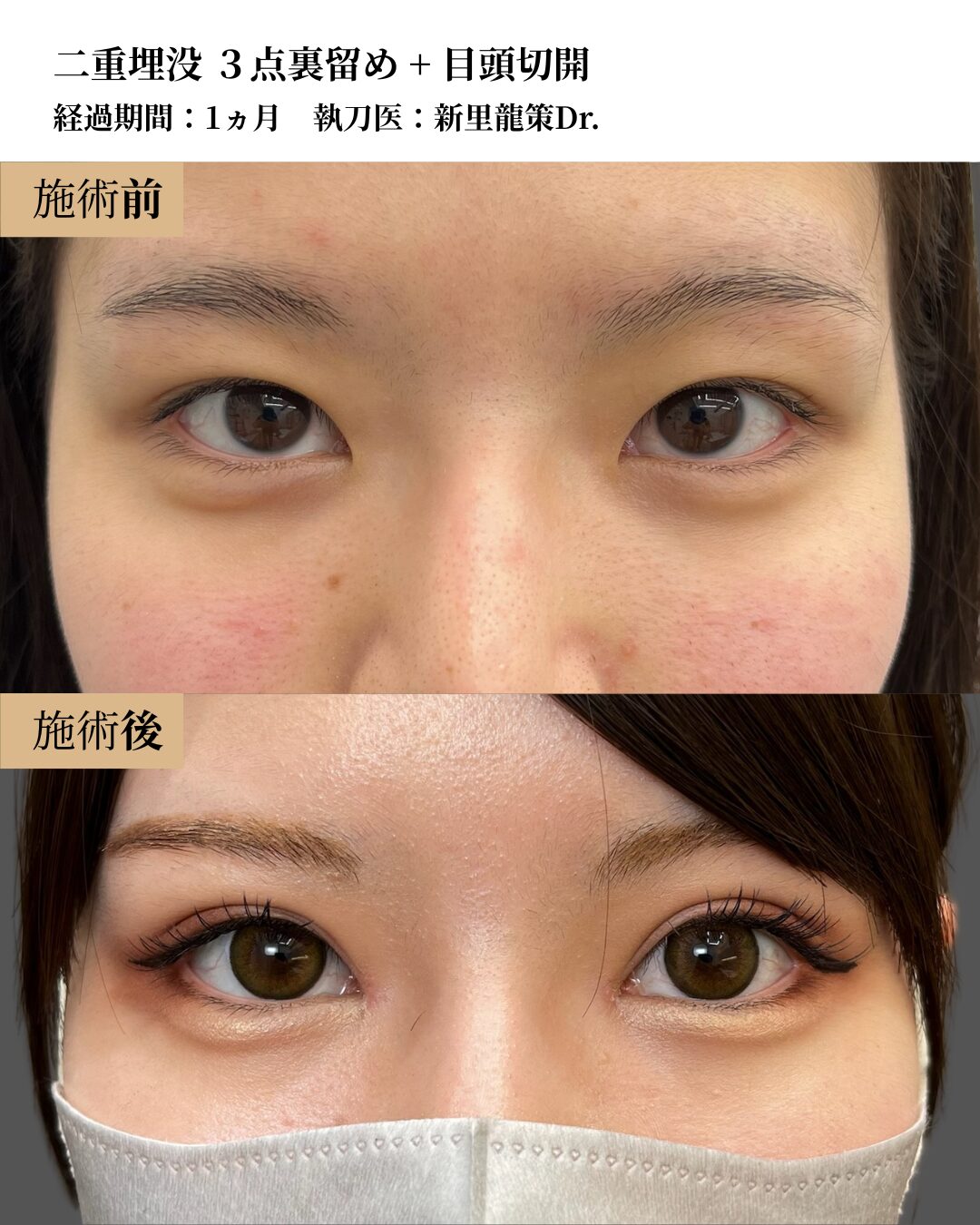 二重術（二重埋没３点裏留め）+ 目頭切開