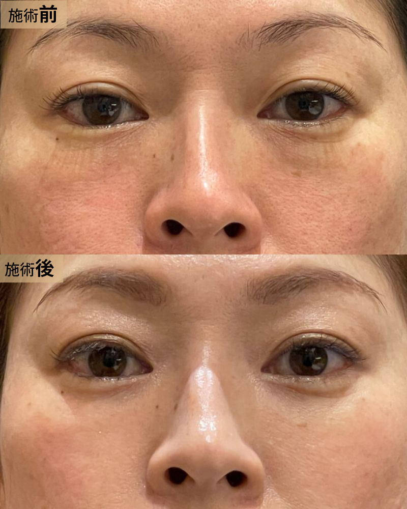 クマ取り＆脂肪注入