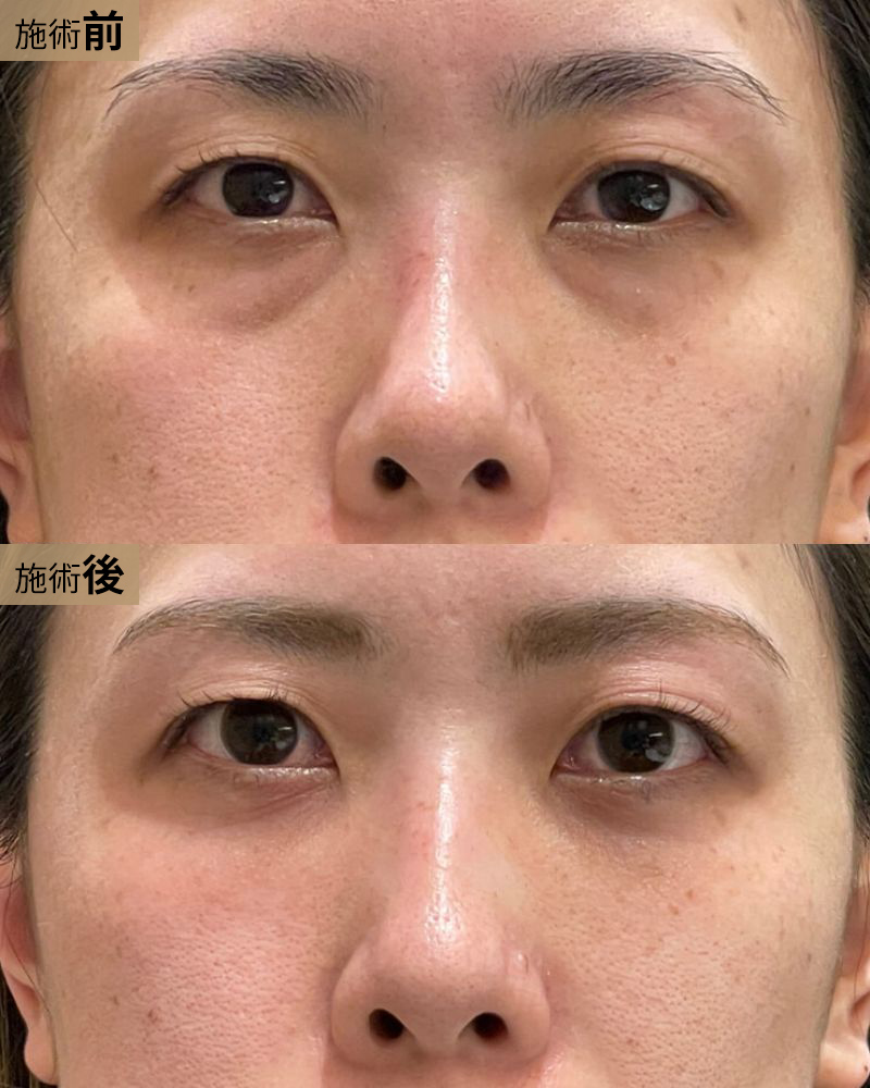 クマ取り＆脂肪注入