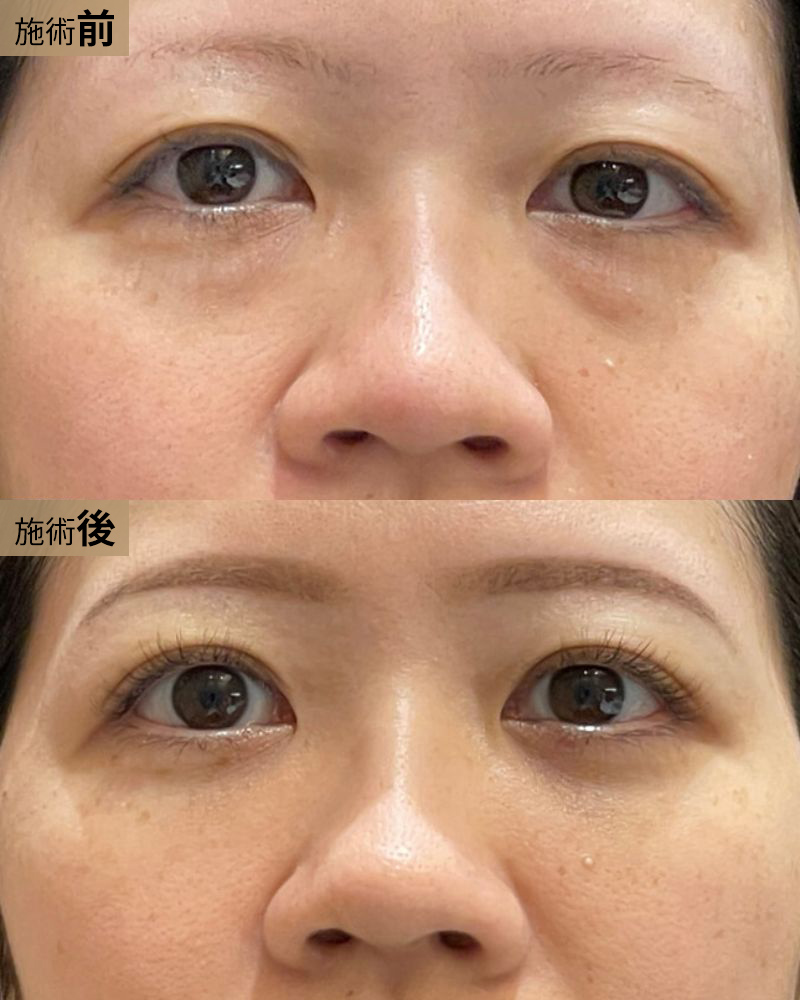 クマ取り＆脂肪注入