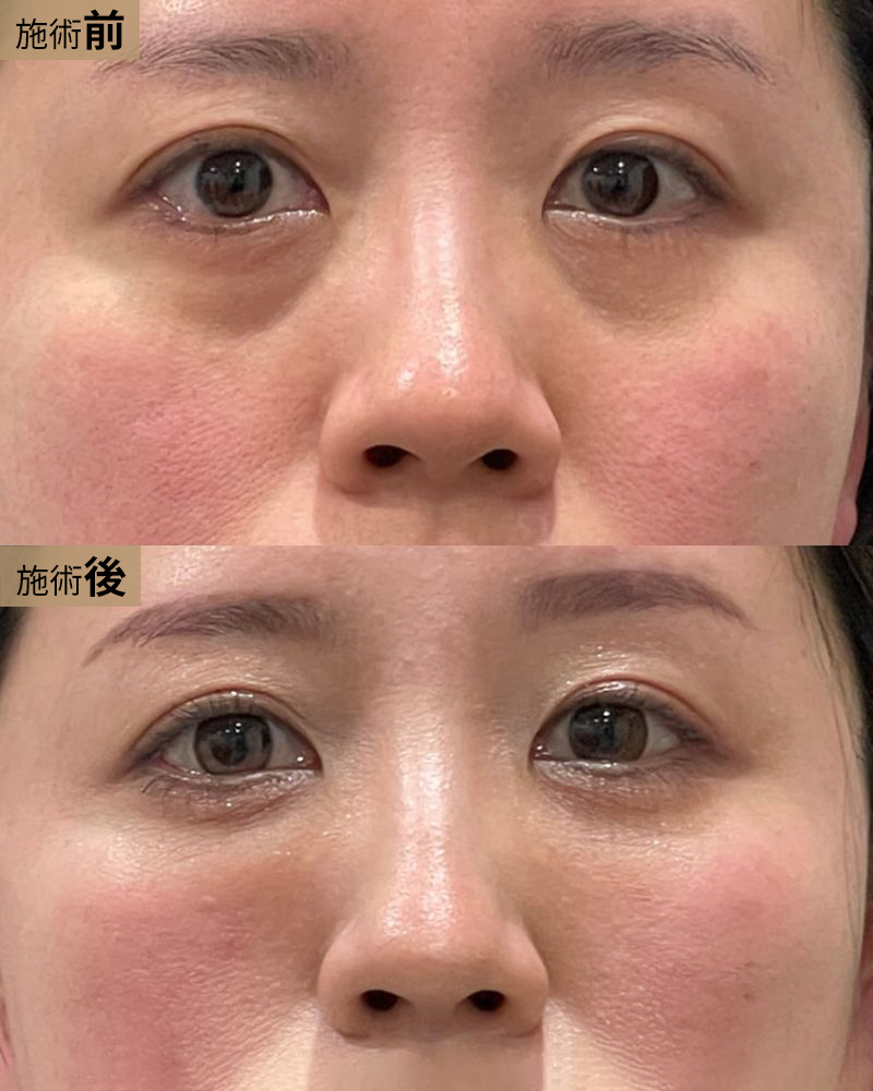 クマ取り＆脂肪注入