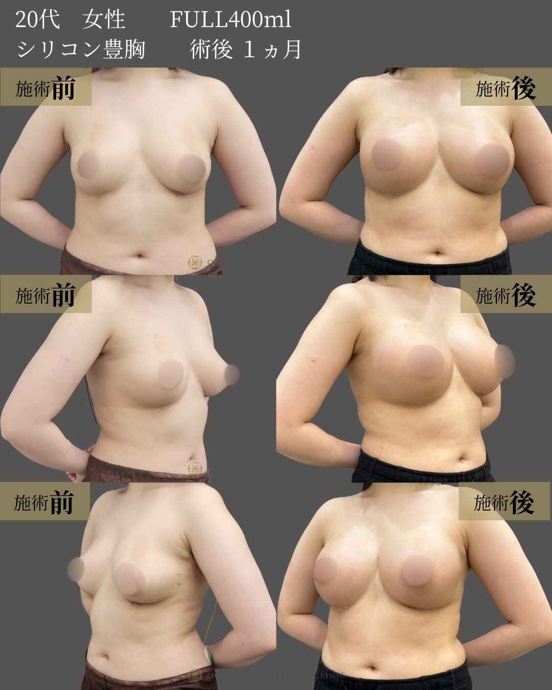 シリコン豊胸