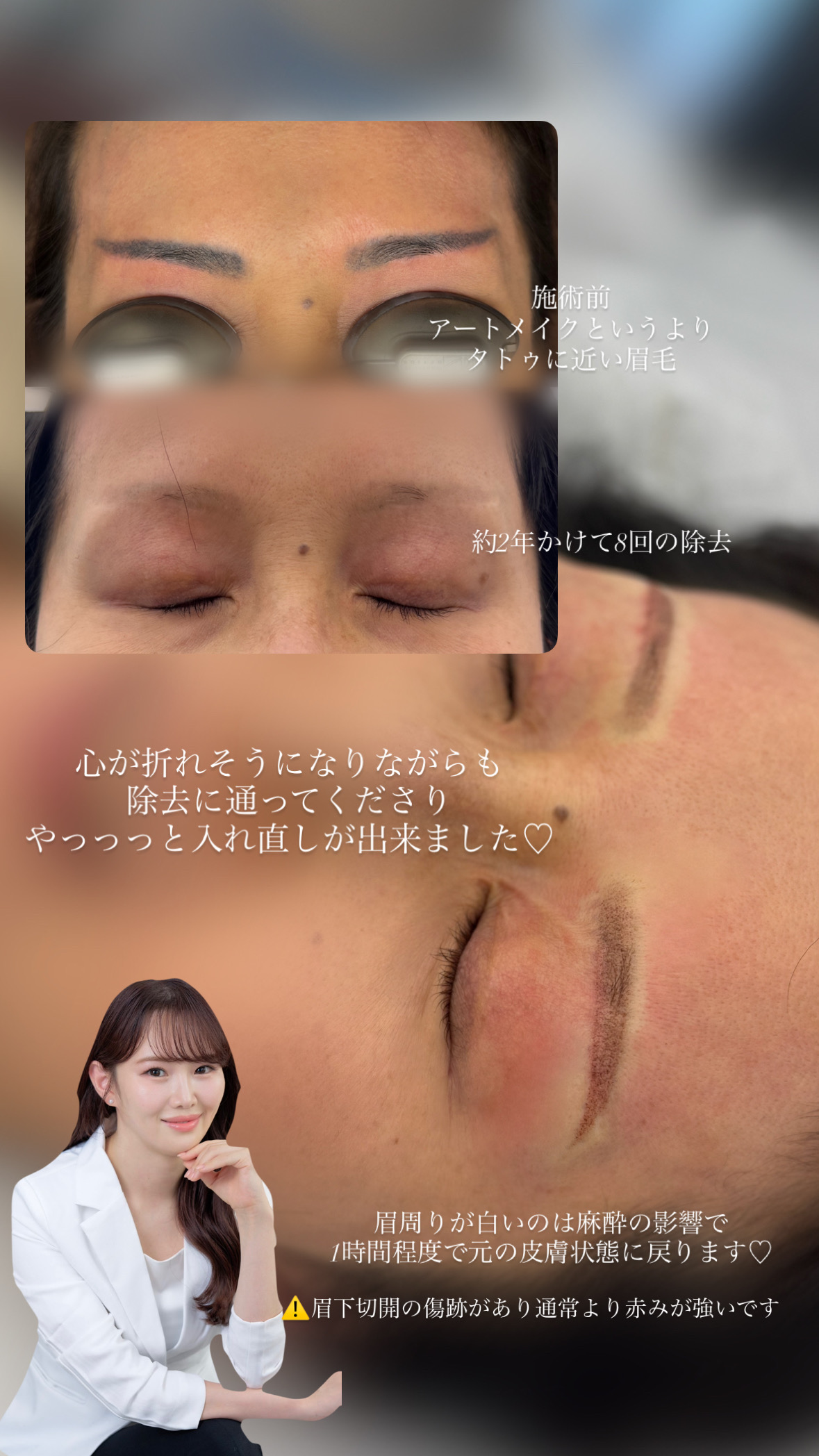 眉アートメイク除去・入れ直しのカウンセリングイメージ