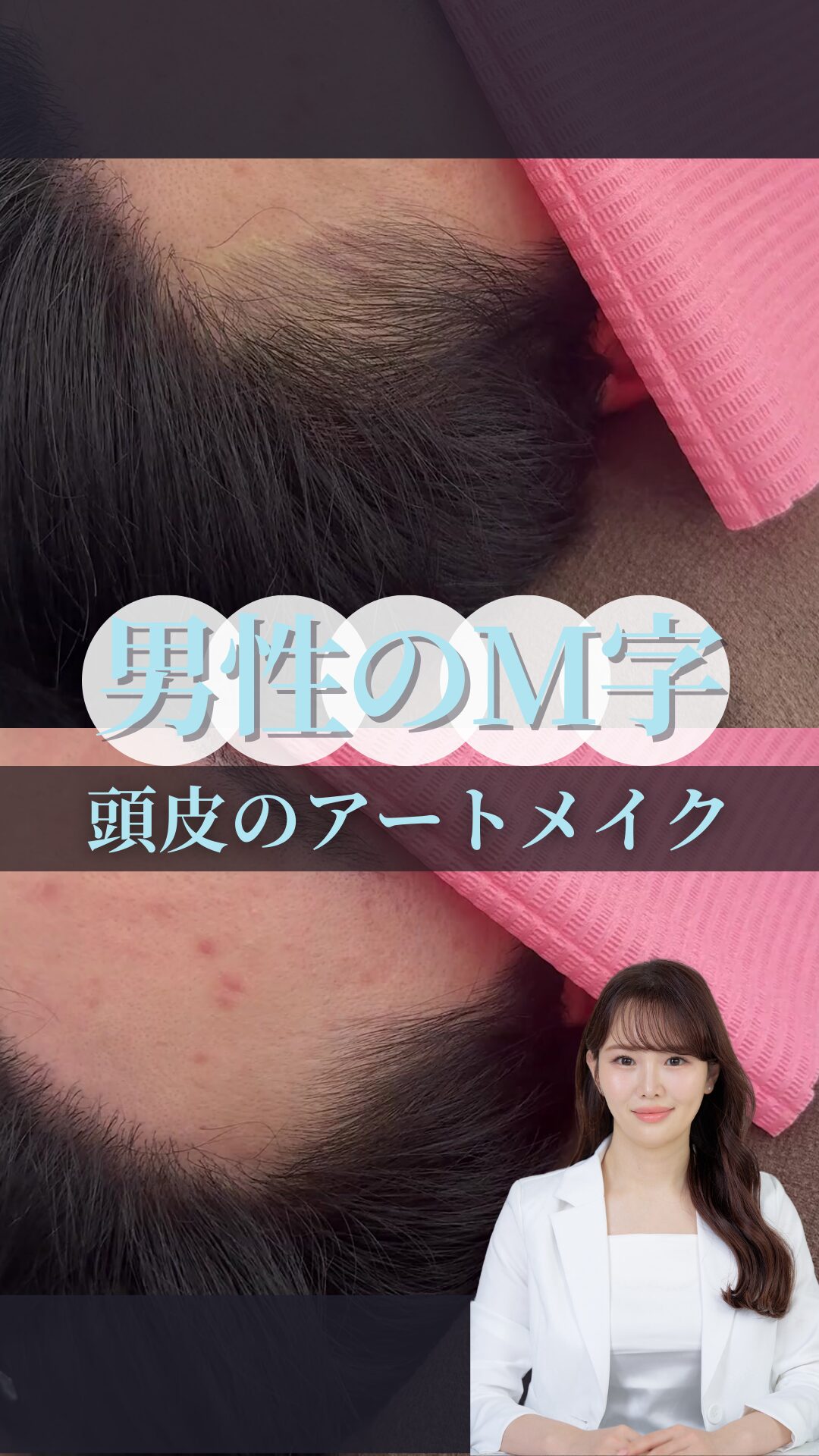 男性のM字生え際アートメイク