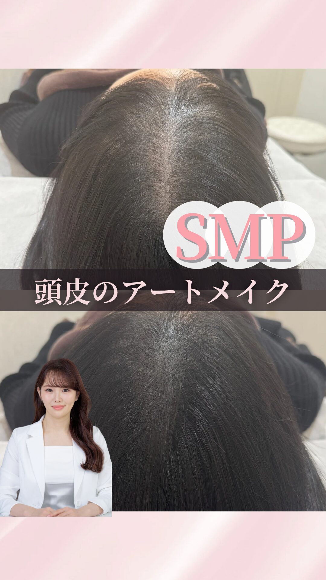 頭皮アートメイク(SMP)による薄毛カバーのイメージ