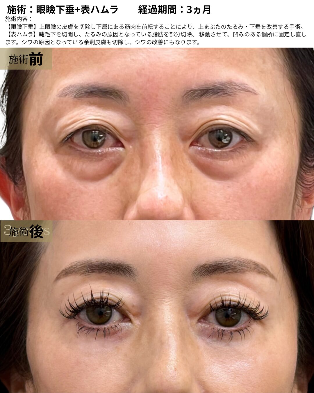 眼瞼下垂+表ハムラ