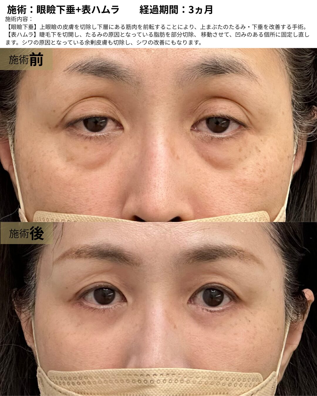 眼瞼下垂+表ハムラ