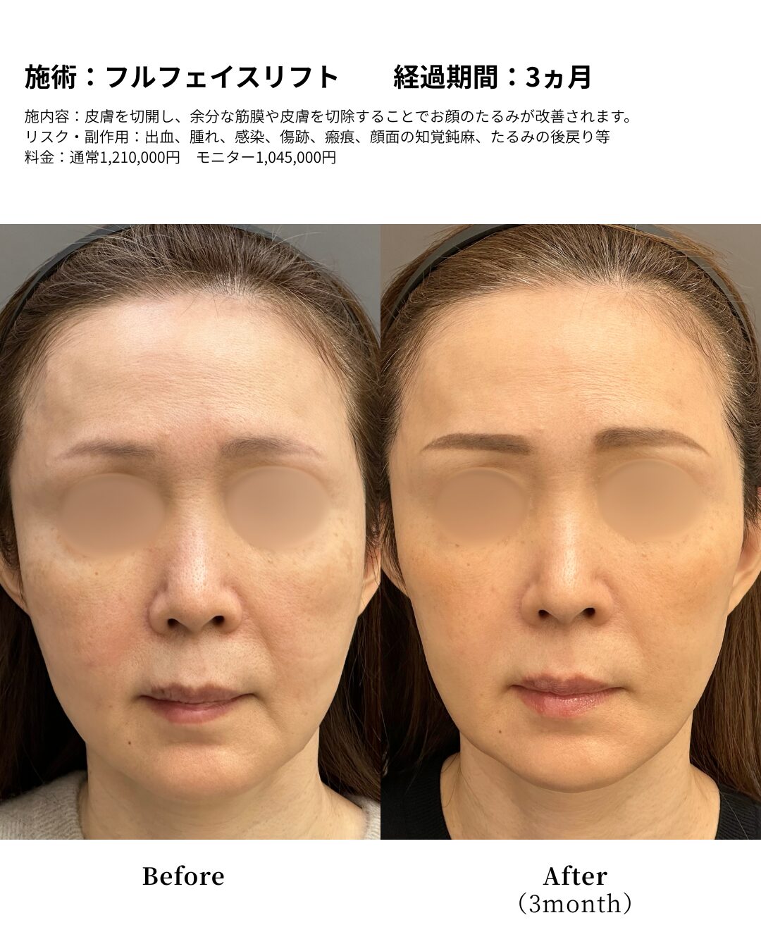 フェイスフルフェイスリフト