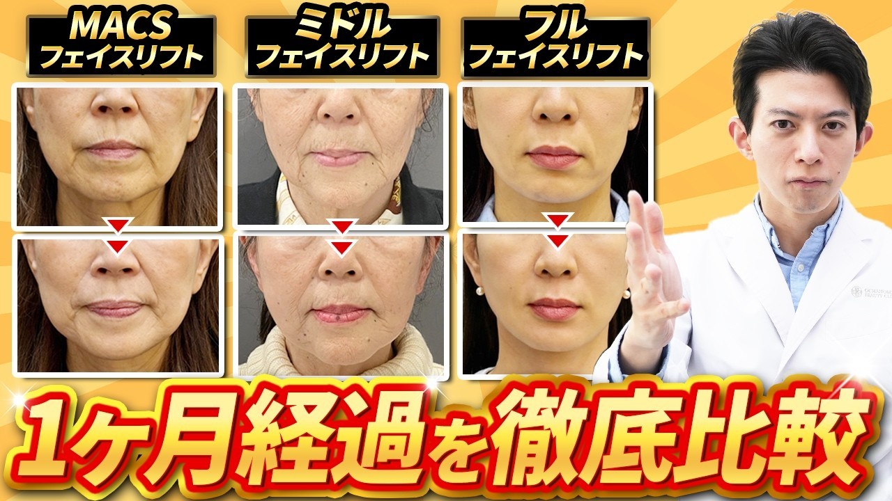 フェイスリフトのダウンタイムは？種類別に効果と術後経過を解説