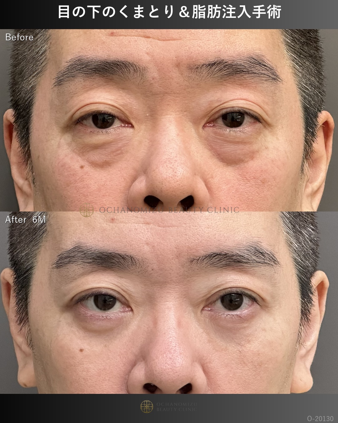 目の下のクマ取り・脂肪注入