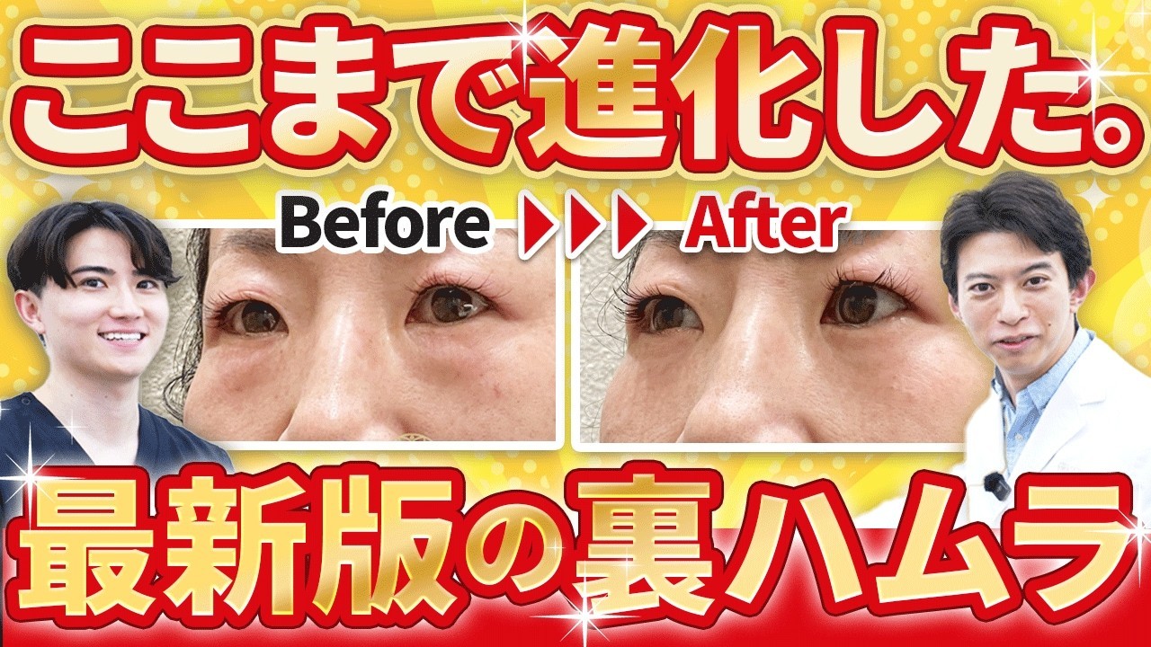 裏ハムラ法の種類と進化を医師が解説！短時間で負担の少ないクマ治療へ