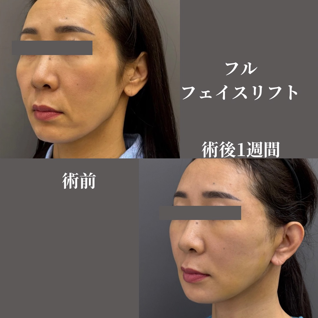 フルフェイスリフト