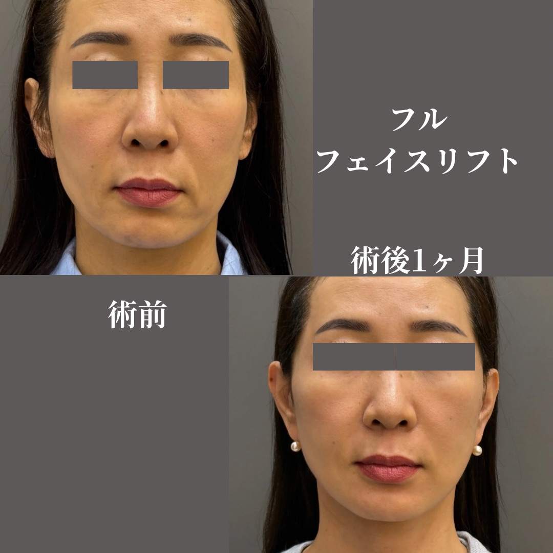 フルフェイスリフト