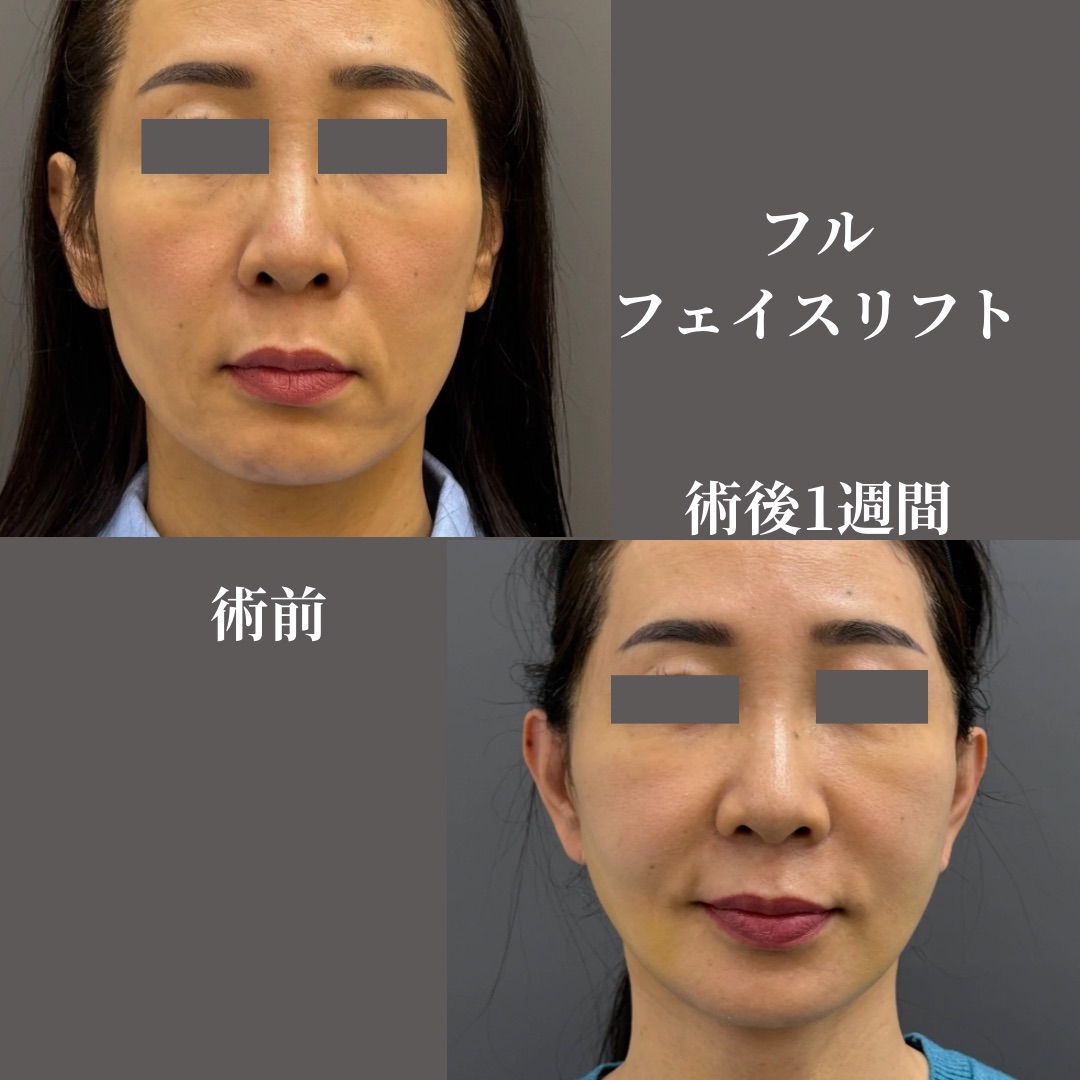 フルフェイスリフト
