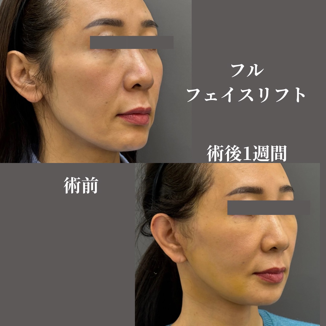 フルフェイスリフト