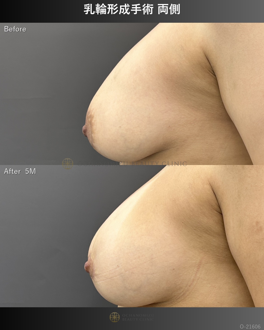 乳輪形成