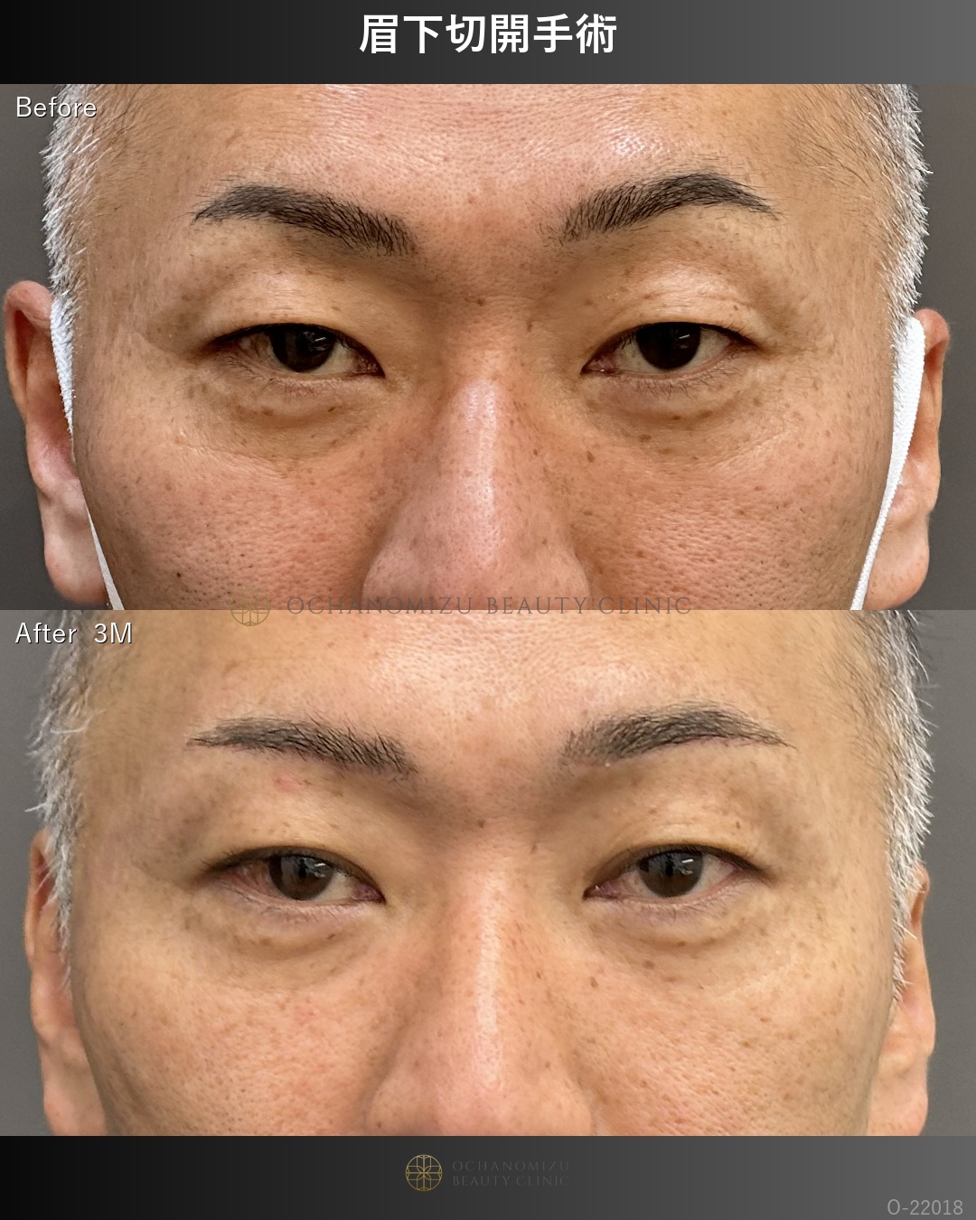 眉下切開