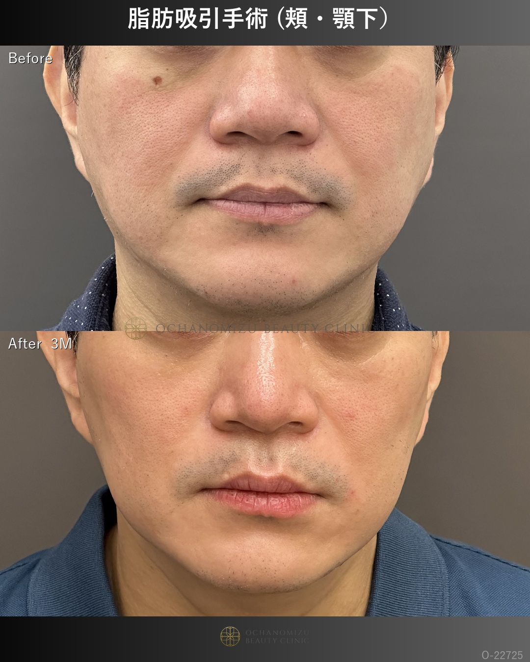 脂肪吸引手術 (頬・顎下）