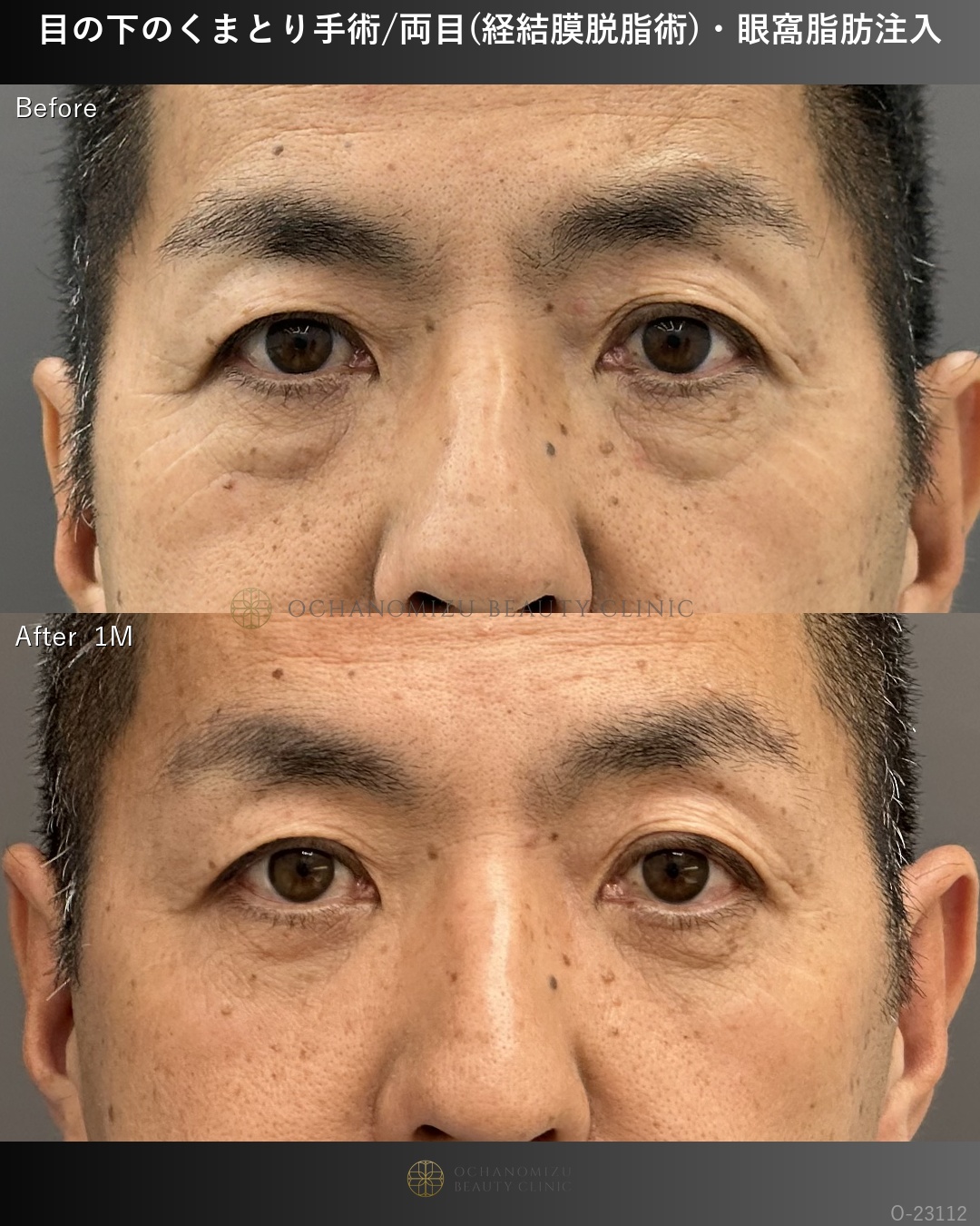 目の下のクマ取り(経結膜脱脂術)＋眼窩脂肪注入
