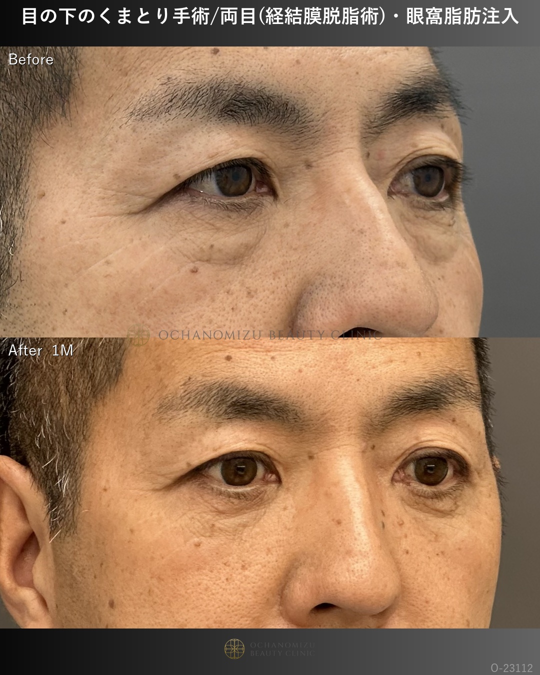 目の下のクマ取り(経結膜脱脂術)＋眼窩脂肪注入