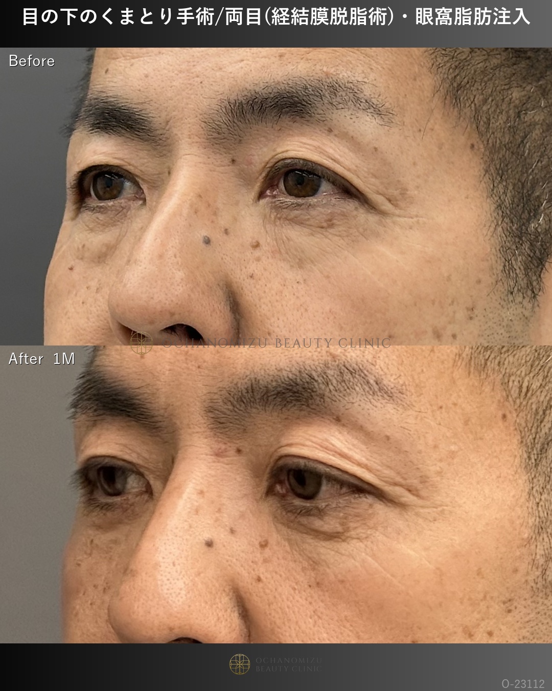 目の下のクマ取り(経結膜脱脂術)＋眼窩脂肪注入