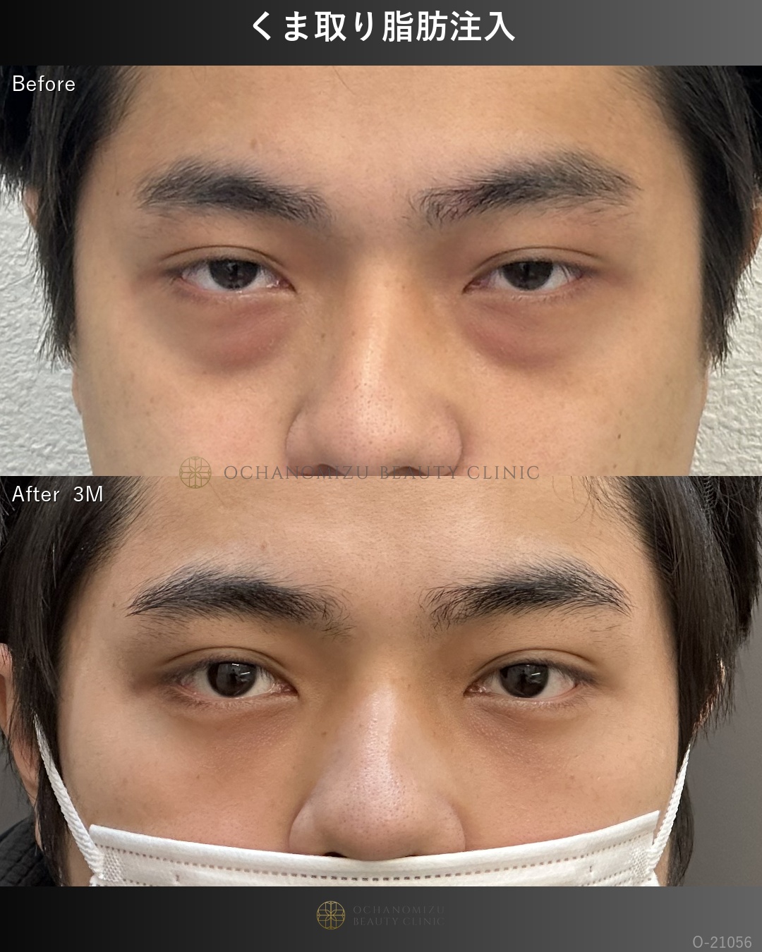 くま取り脂肪注入