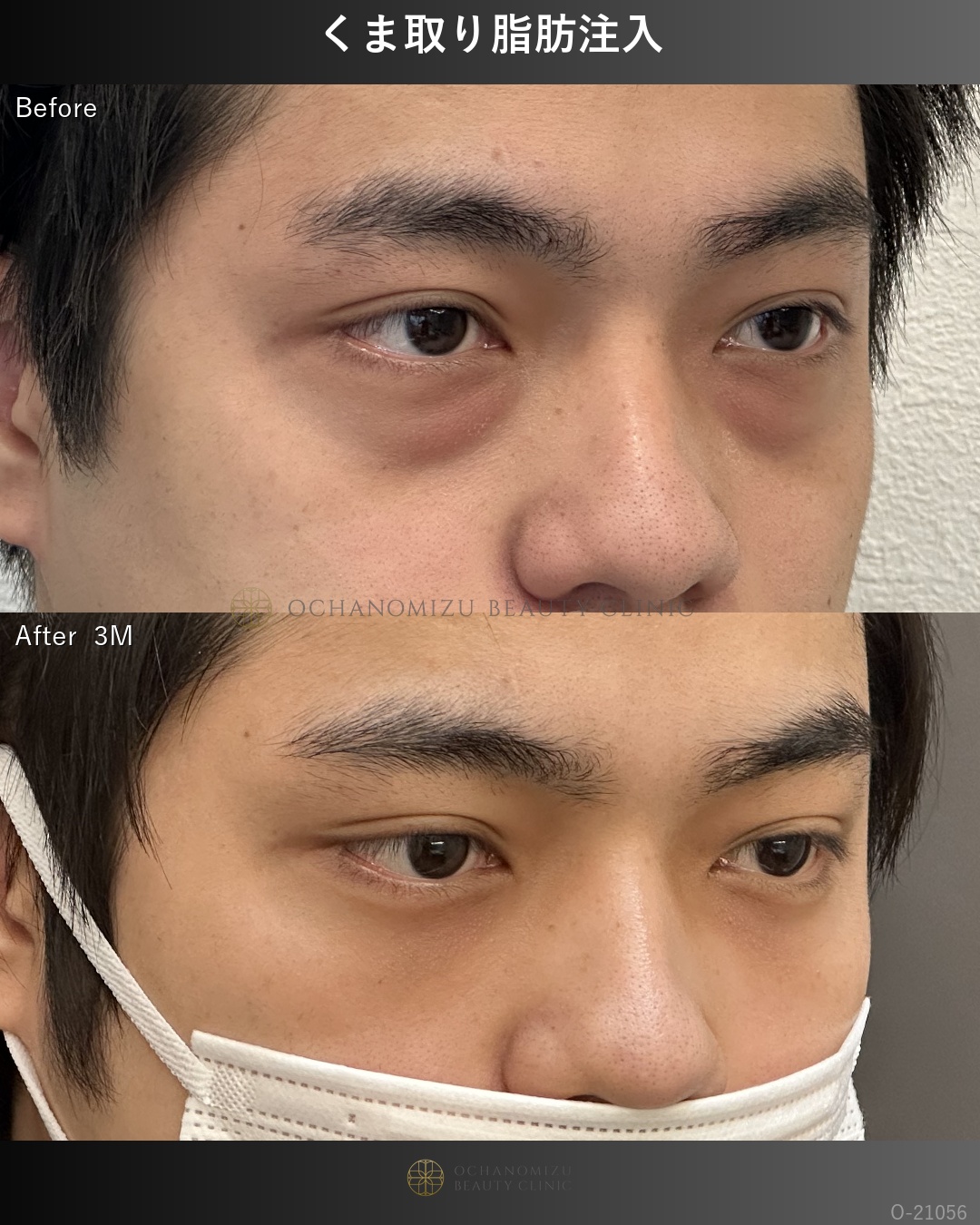 くま取り脂肪注入