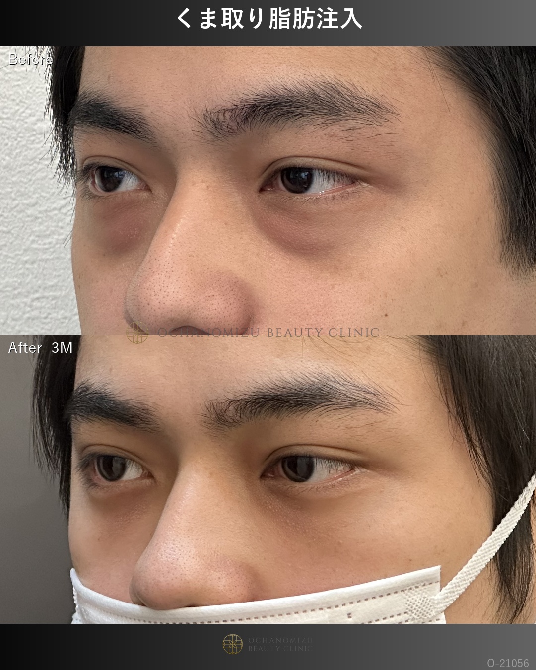 くま取り脂肪注入