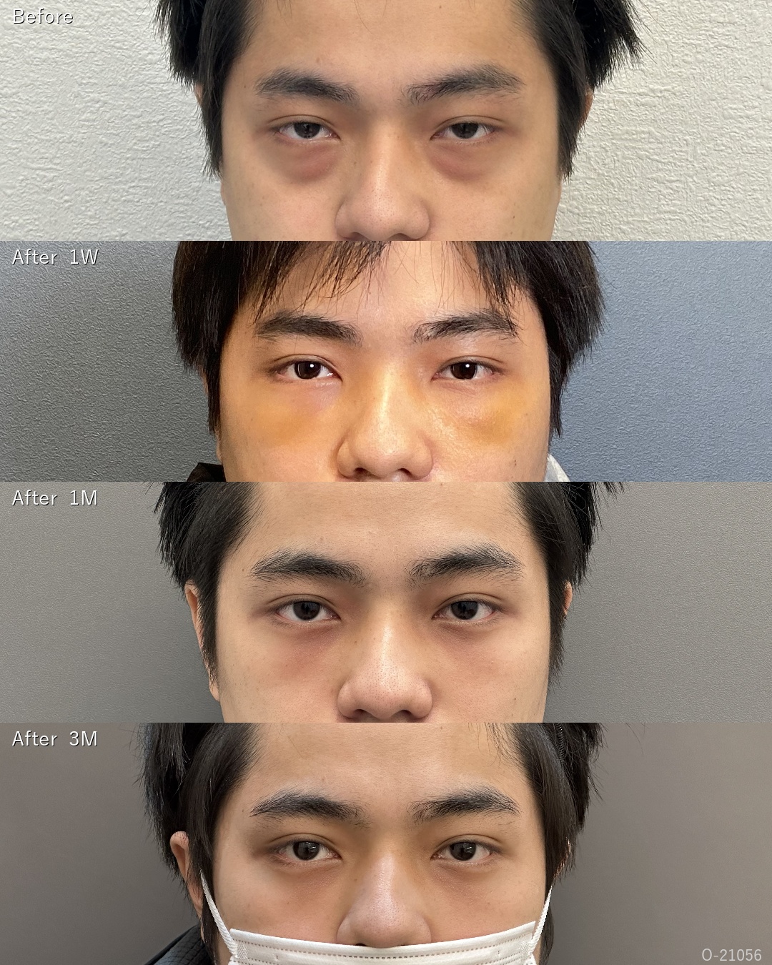 くま取り脂肪注入