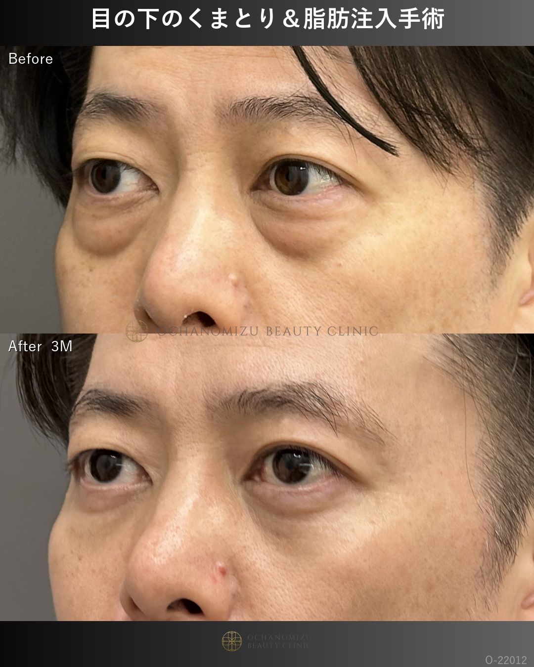 目の下のクマ取り・脂肪注入