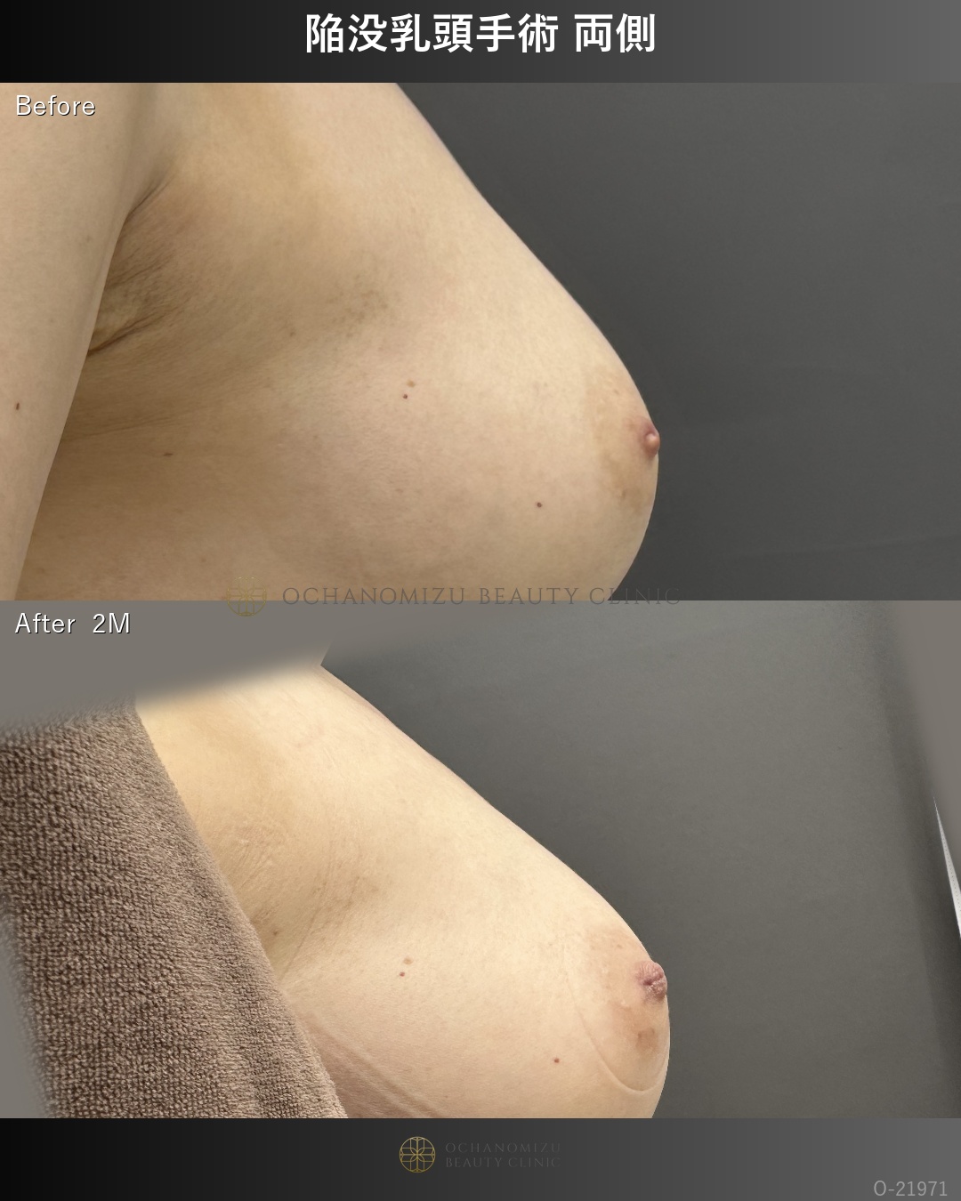 陥没乳頭