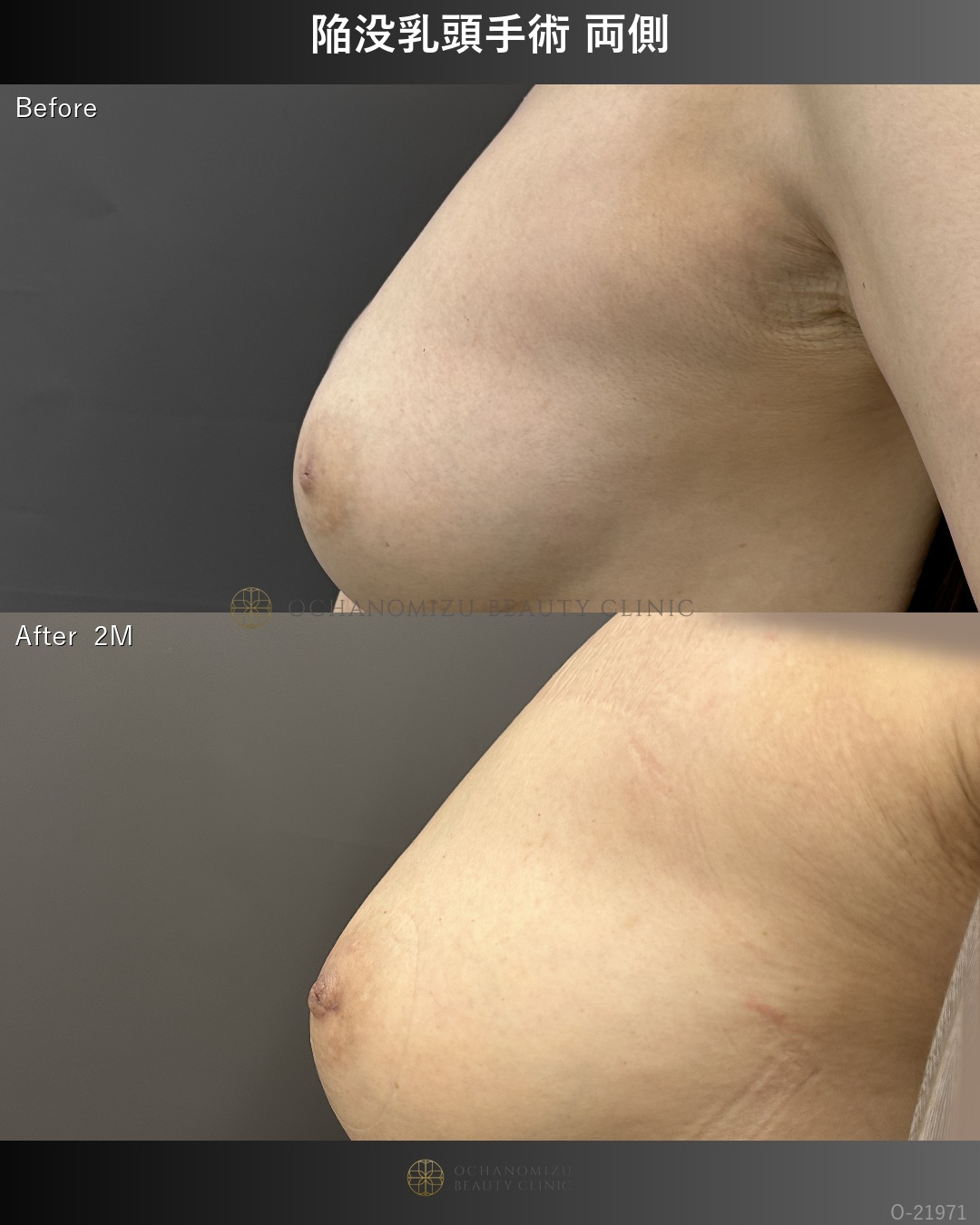 陥没乳頭