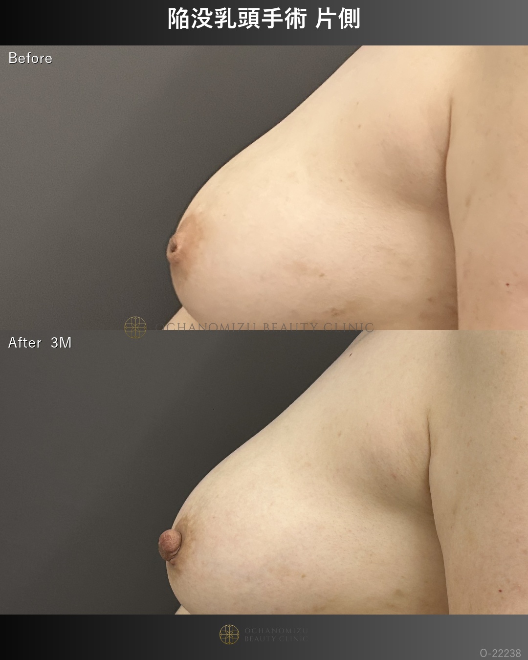 陥没乳頭
