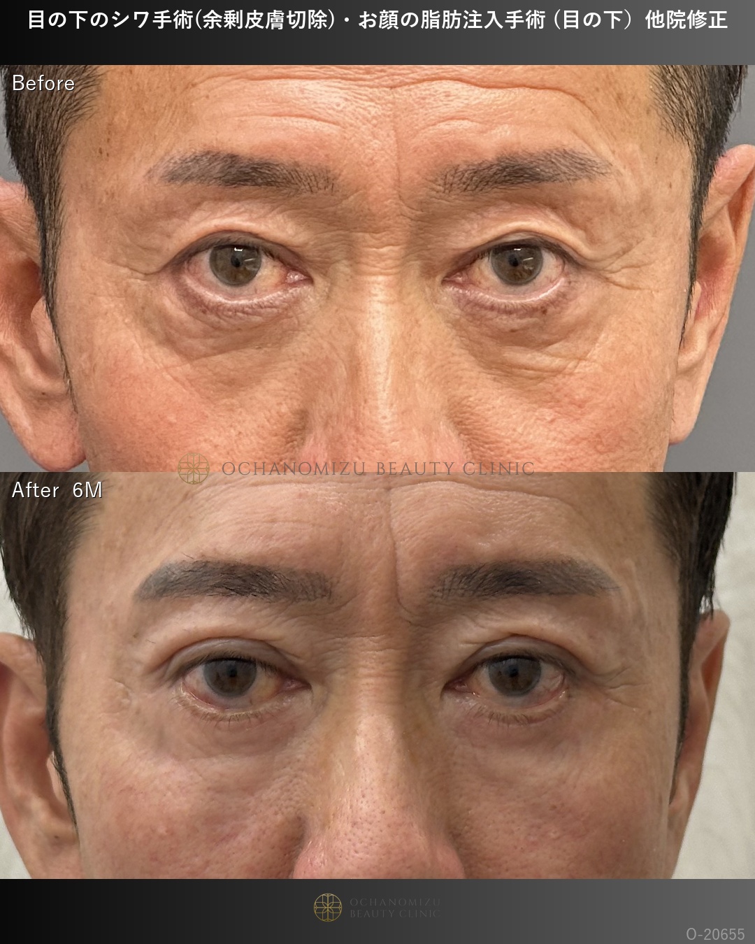目の下のシワ手術(余剰皮膚切除)＋顔の脂肪注入