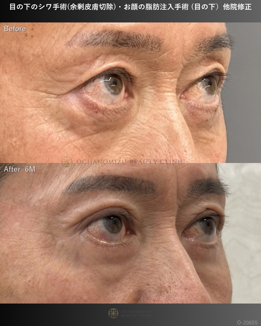 目の下のシワ手術(余剰皮膚切除)＋顔の脂肪注入