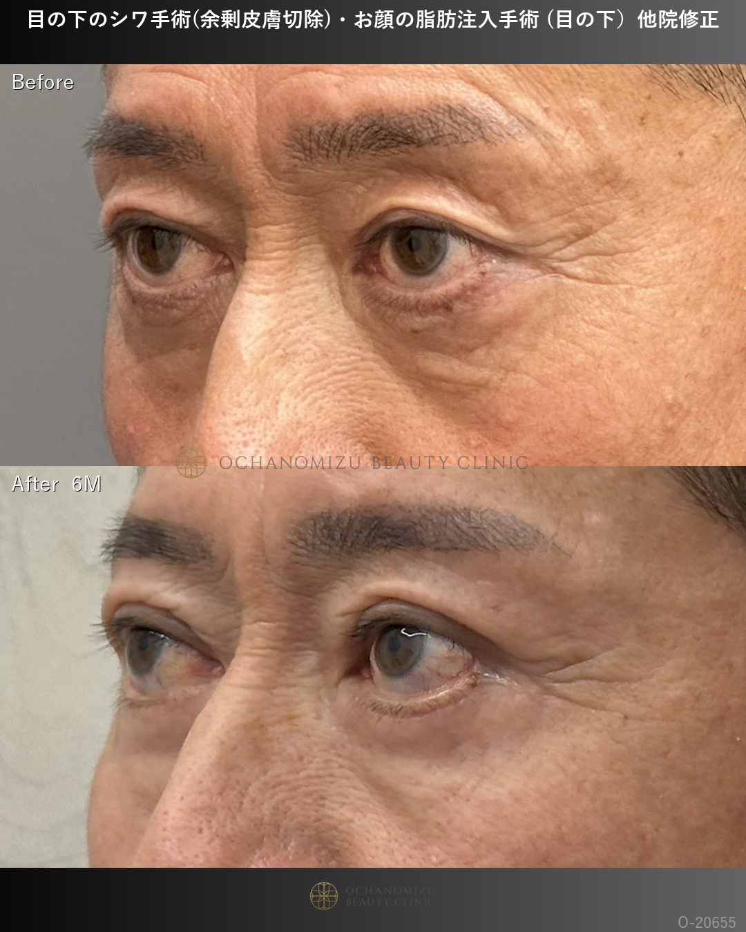 目の下のシワ手術(余剰皮膚切除)＋顔の脂肪注入