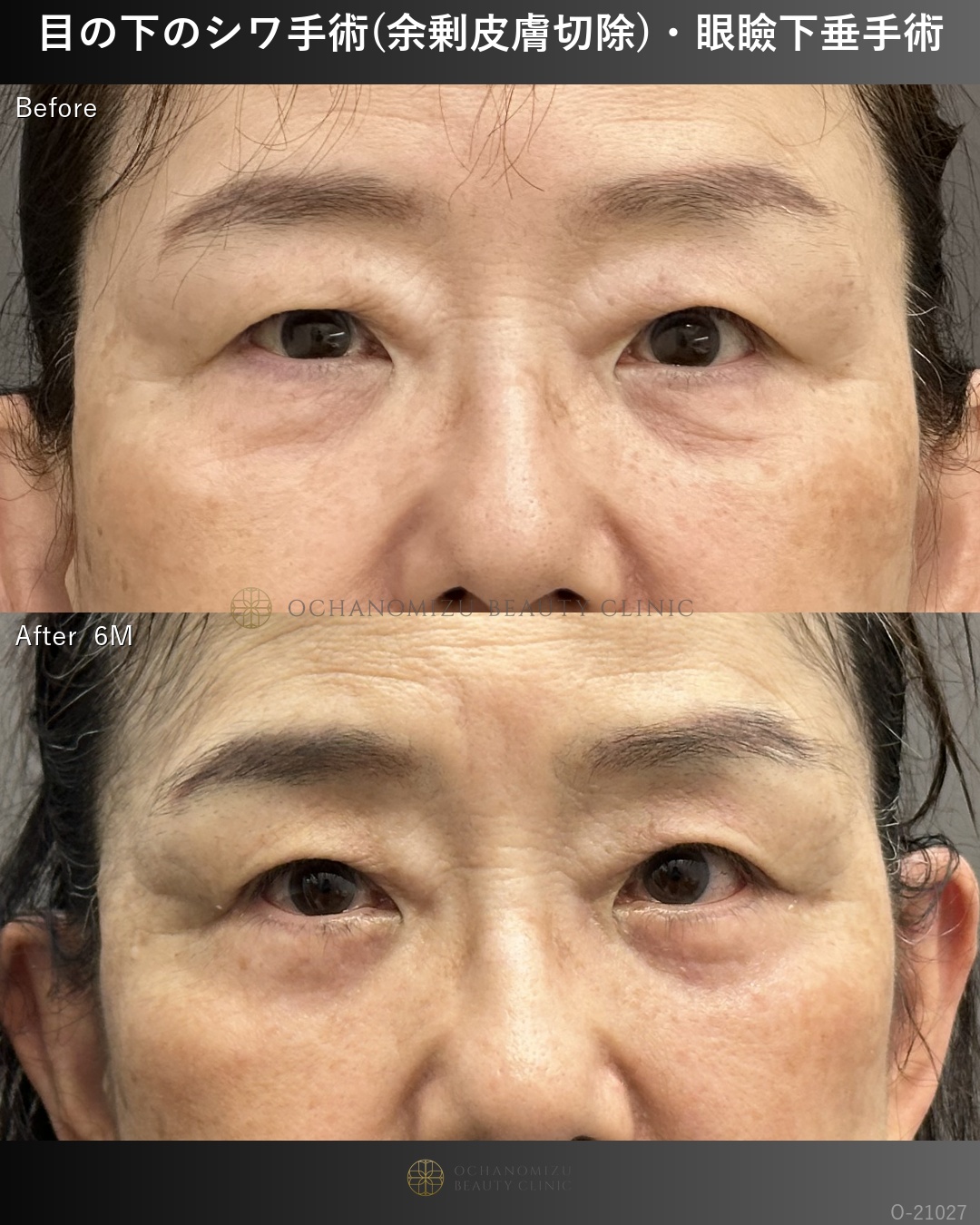 目の下のシワ手術(余剰皮膚切除)＋眼瞼下垂術