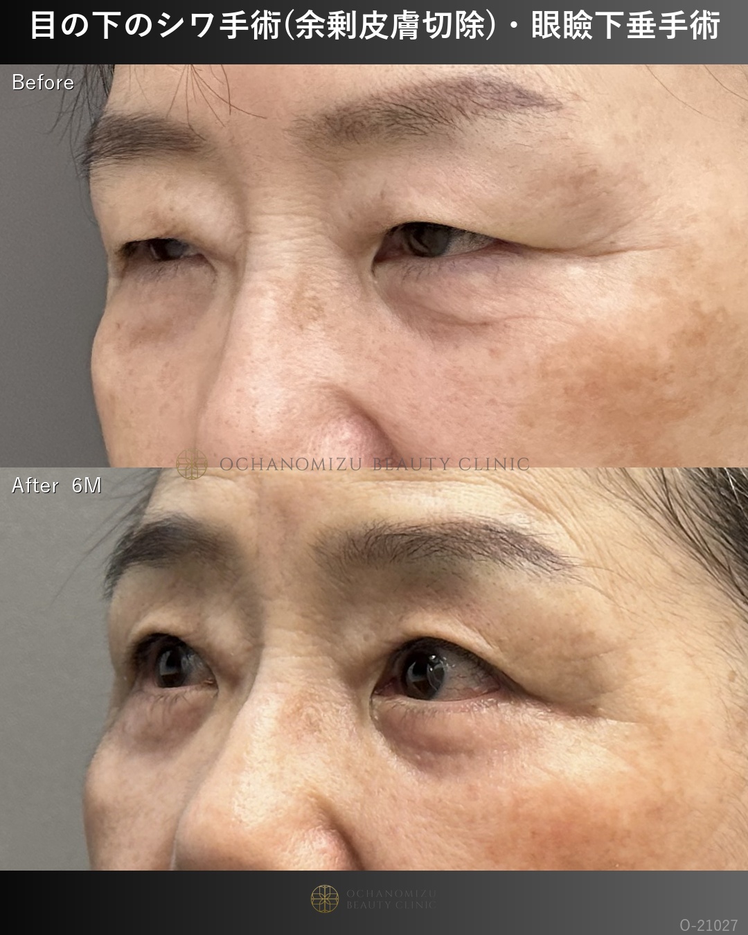 目の下のシワ手術(余剰皮膚切除)＋眼瞼下垂術