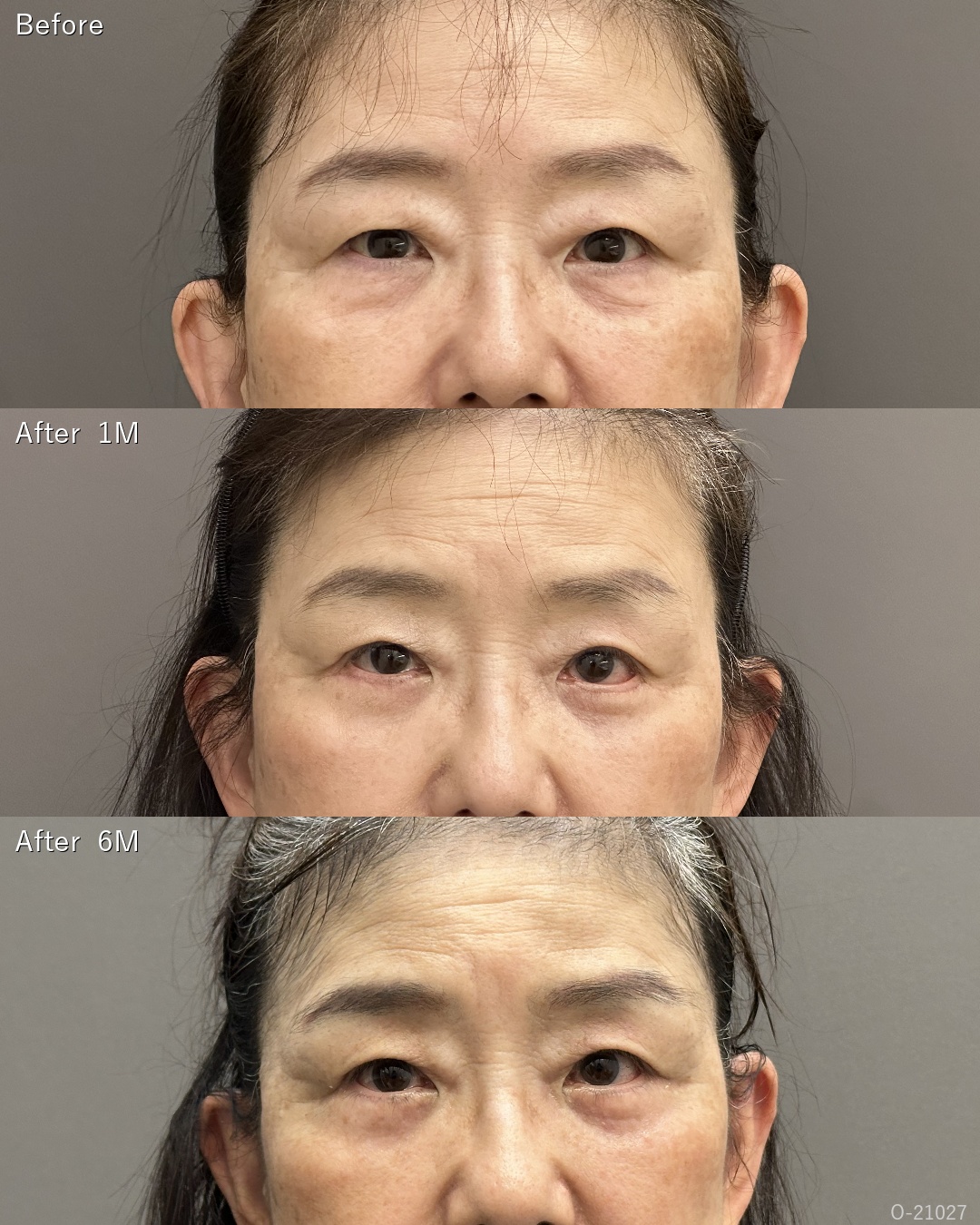 目の下のシワ手術(余剰皮膚切除)＋眼瞼下垂術