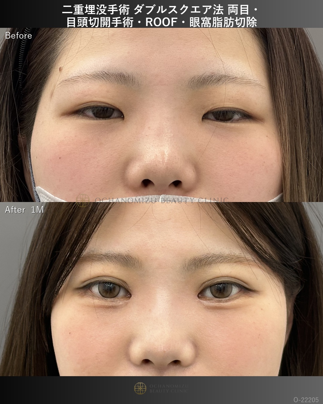 二重埋没＋目頭切開