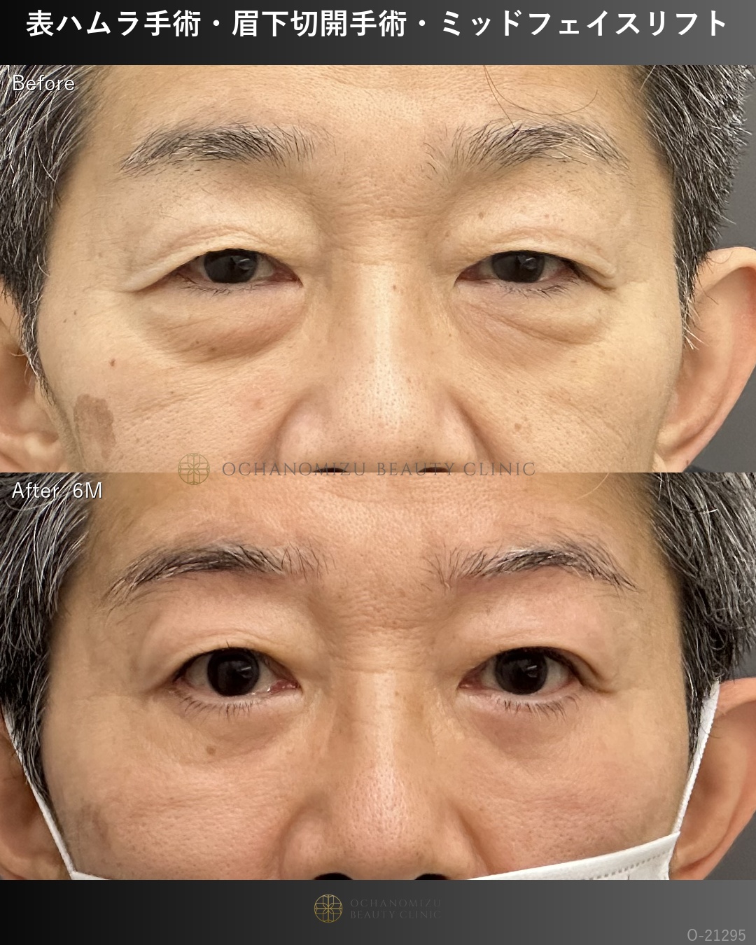 表ハムラ＋眉下切開＋ミッドフェイスリフト
