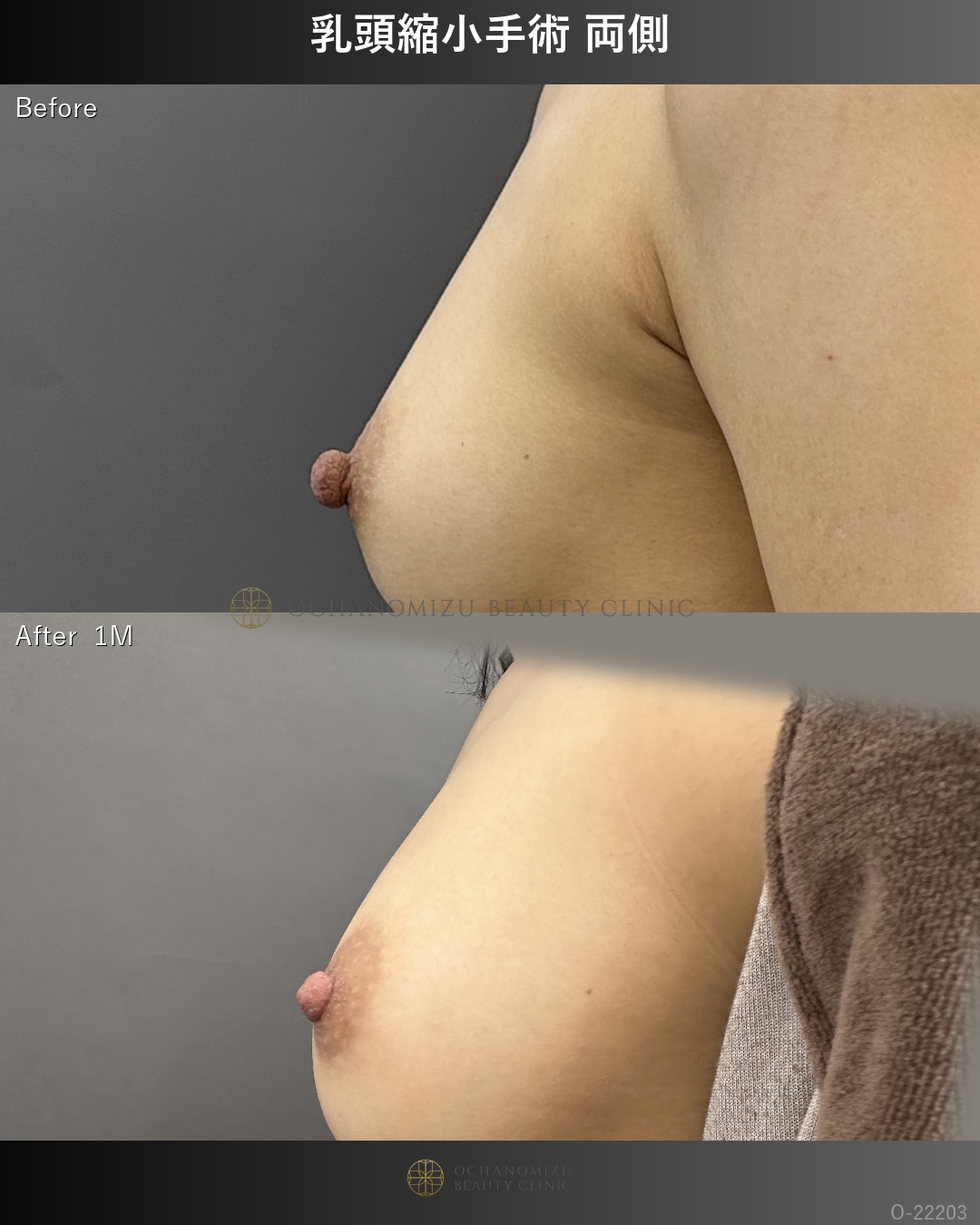 乳頭縮小