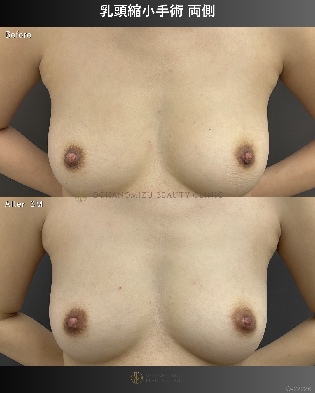 乳頭縮小
